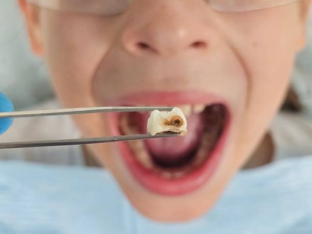 Best Same-Day Emergency Dental Services in Lynchburg, MS